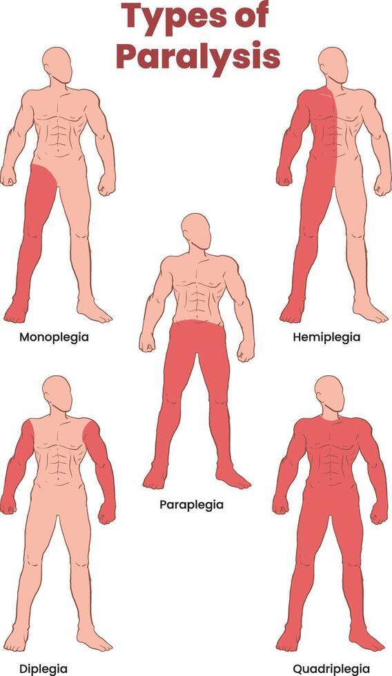 types of paralysis illustration vector