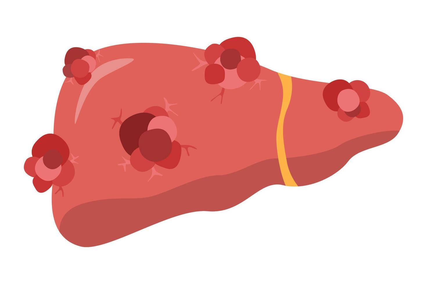 hígado cáncer célula crecimiento. cáncer enfermedad concepto vector