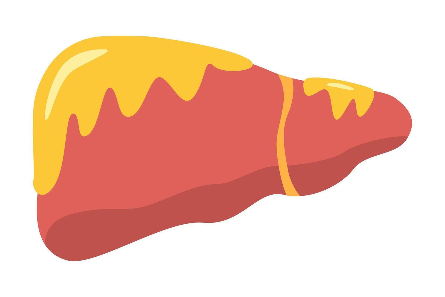 fatty liver disease. illustration vector