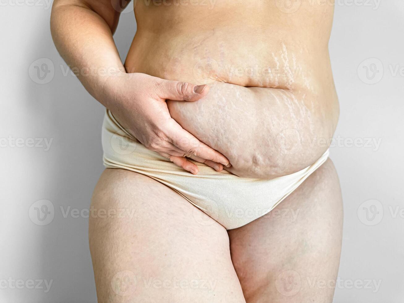 Postpartum womans midsection showing stretch marks, body positivity and real post pregnancy changes concept. photo
