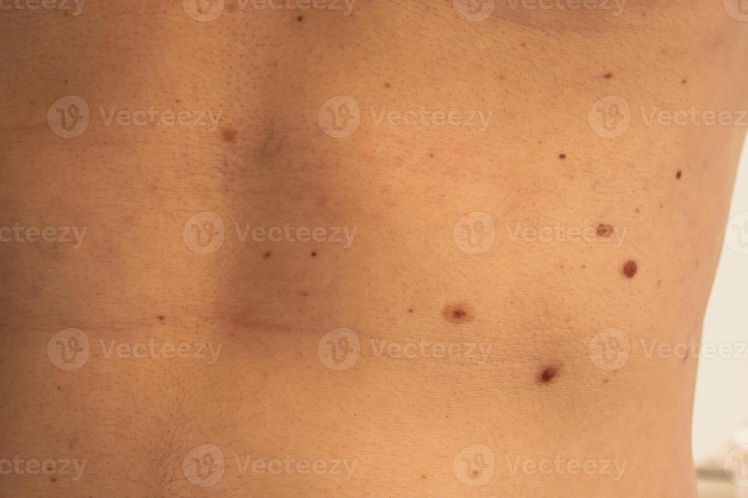 Male showing birthmarks on skin body stomach part. Close up detail of the bare skin. Health Effects of UV Radiation. Man with birthmarks Pigmentation and lot of birthmarks photo