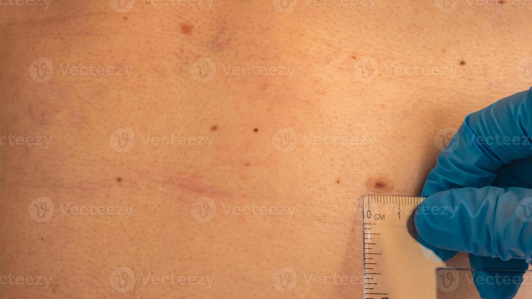 Dermatologist checking sizes of male birthmarks with ruler. Doctor examining length and width of benign moles on man skin Pigmentation. photo