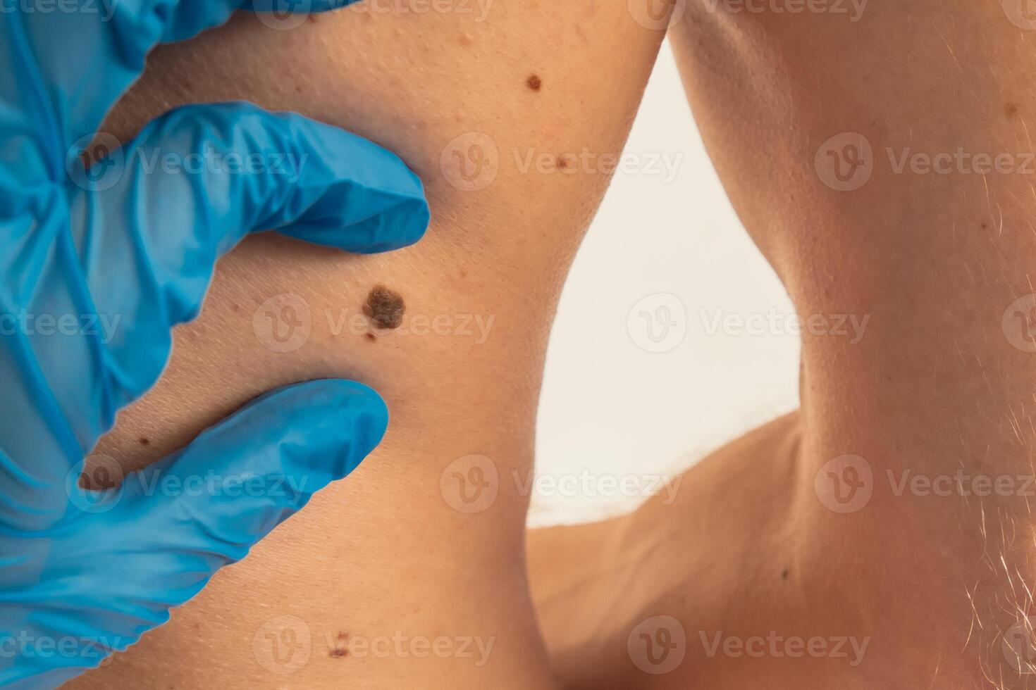 Dermatologist checking male birthmarks for changing size. Annual rechecking. Doctor in medical gloves examining man skin mole. Self care preventing cancer procedure. Protection treatment. Imperfection skin positivity photo