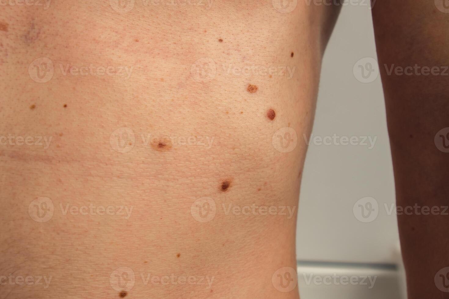 Unrecognizable man showing his birthmarks on skin Close up detail of the bare skin Sun Exposure effect on skin. Health Effects of UV Radiation Male with birthmarks Pigmentation and lot of birthmarks photo