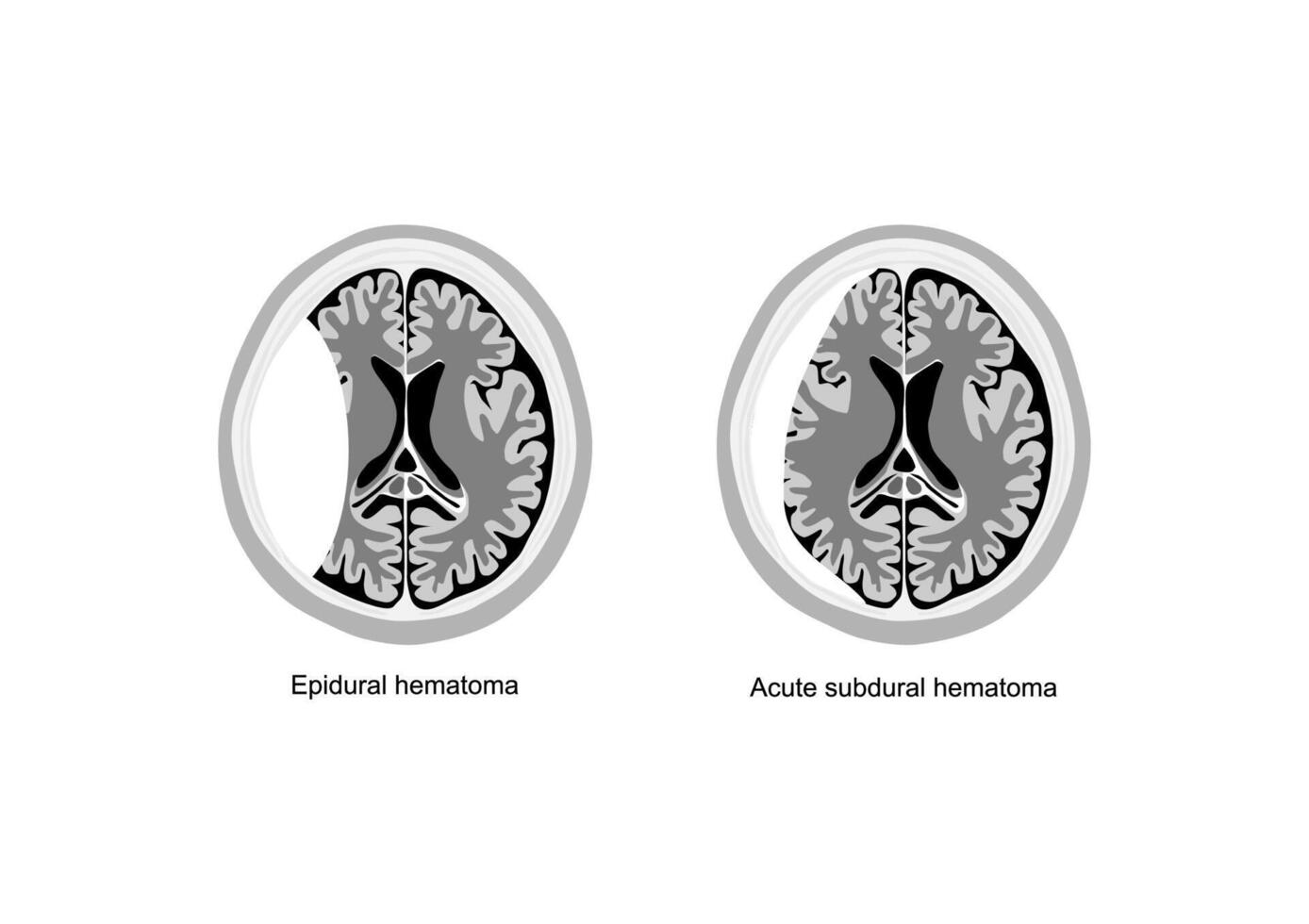 Comparative medical illustration of epidural and acute subdural hematoma in the human brain. vector