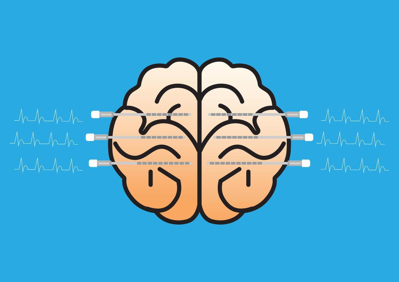 illustration of a brain with stereoelectroencephalography or SEEG electrodes inserted in the brain for epilepsy diagnostic. vector