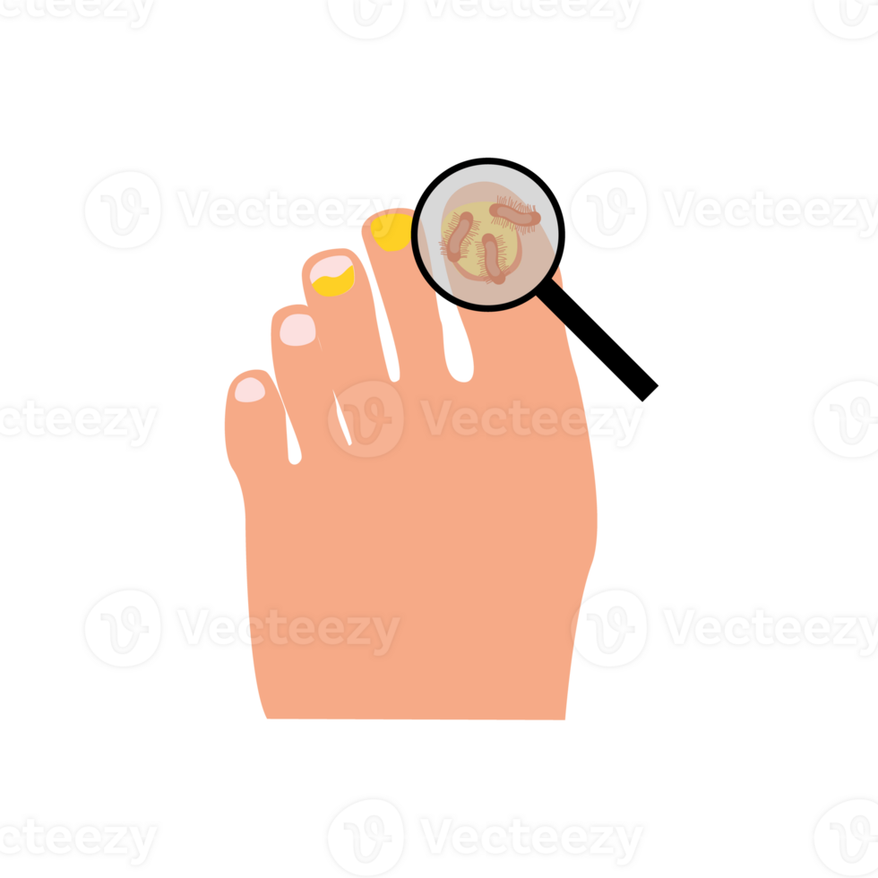 Onychomycosis. Feet with nail disease. Fungal nails infection. Doctors exam, treat nails psoriasis. png