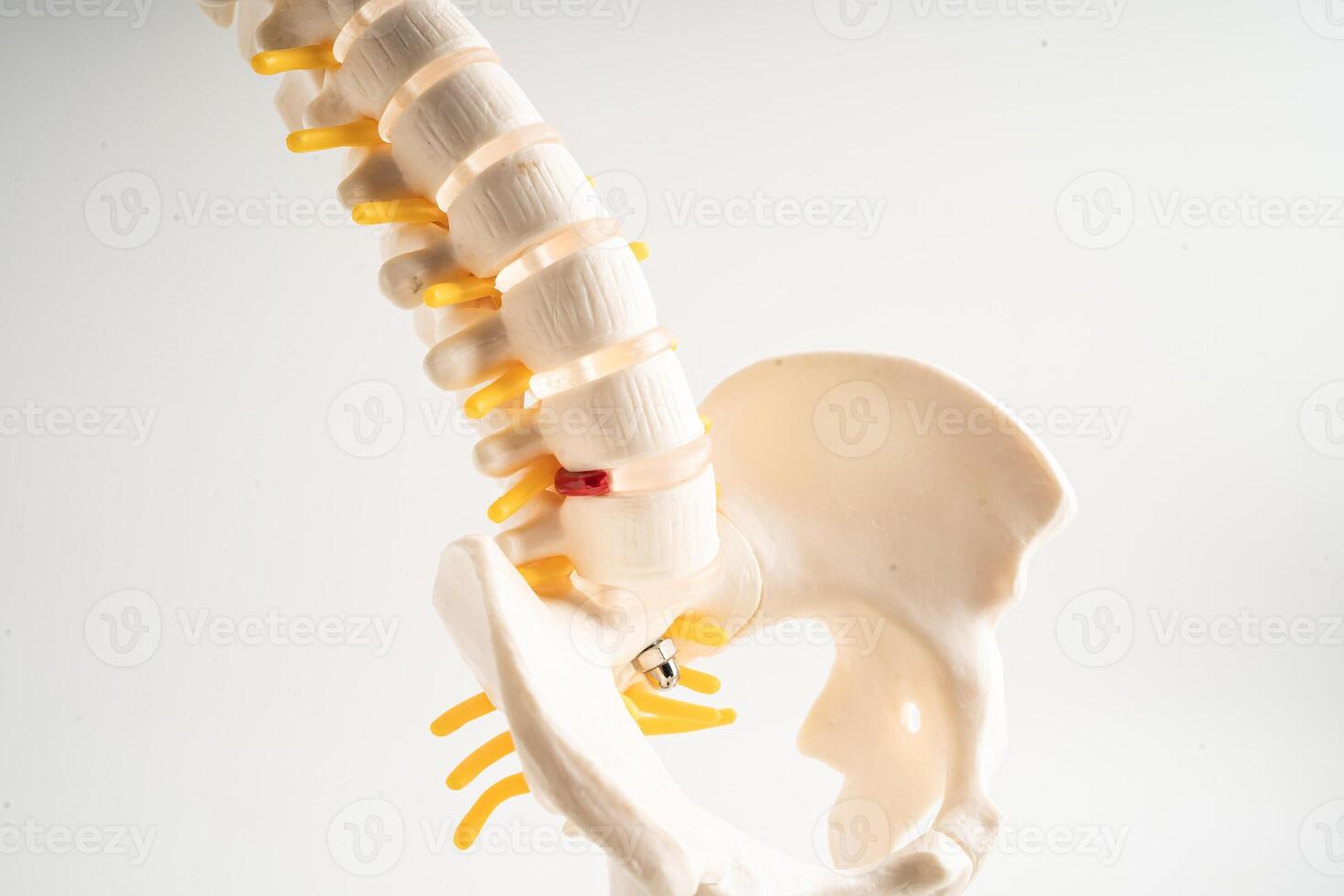 Lumbar spine displaced herniated disc fragment, spinal nerve and bone. Model for treatment medical in the orthopedic department. photo