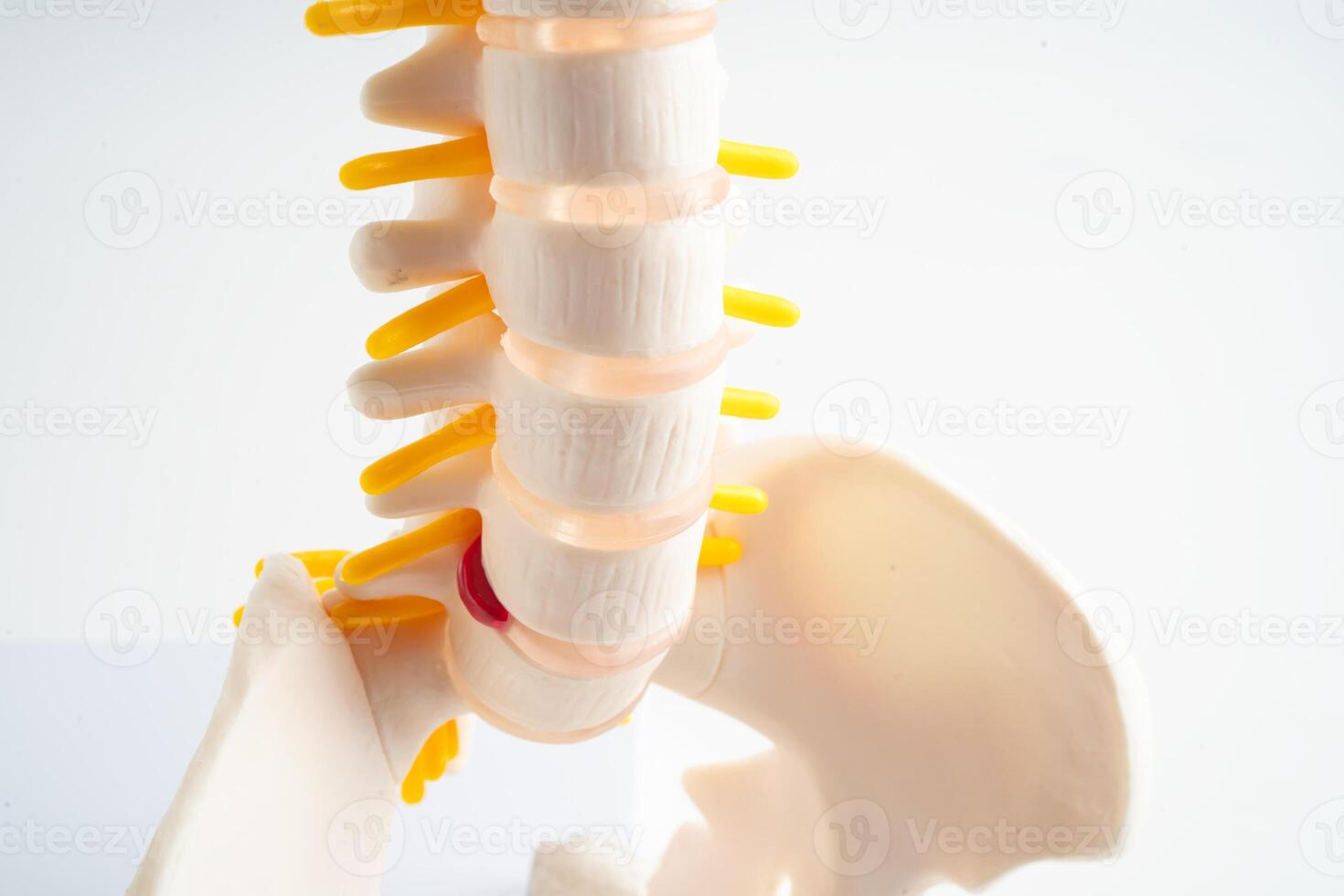 Lumbar spine displaced herniated disc fragment, spinal nerve and bone. Model for treatment medical in the orthopedic department. photo