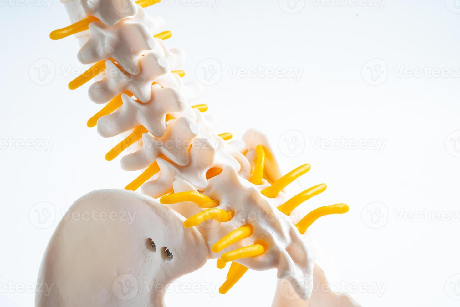 Lumbar spine displaced herniated disc fragment, spinal nerve and bone. Model for treatment medical in the orthopedic department. photo