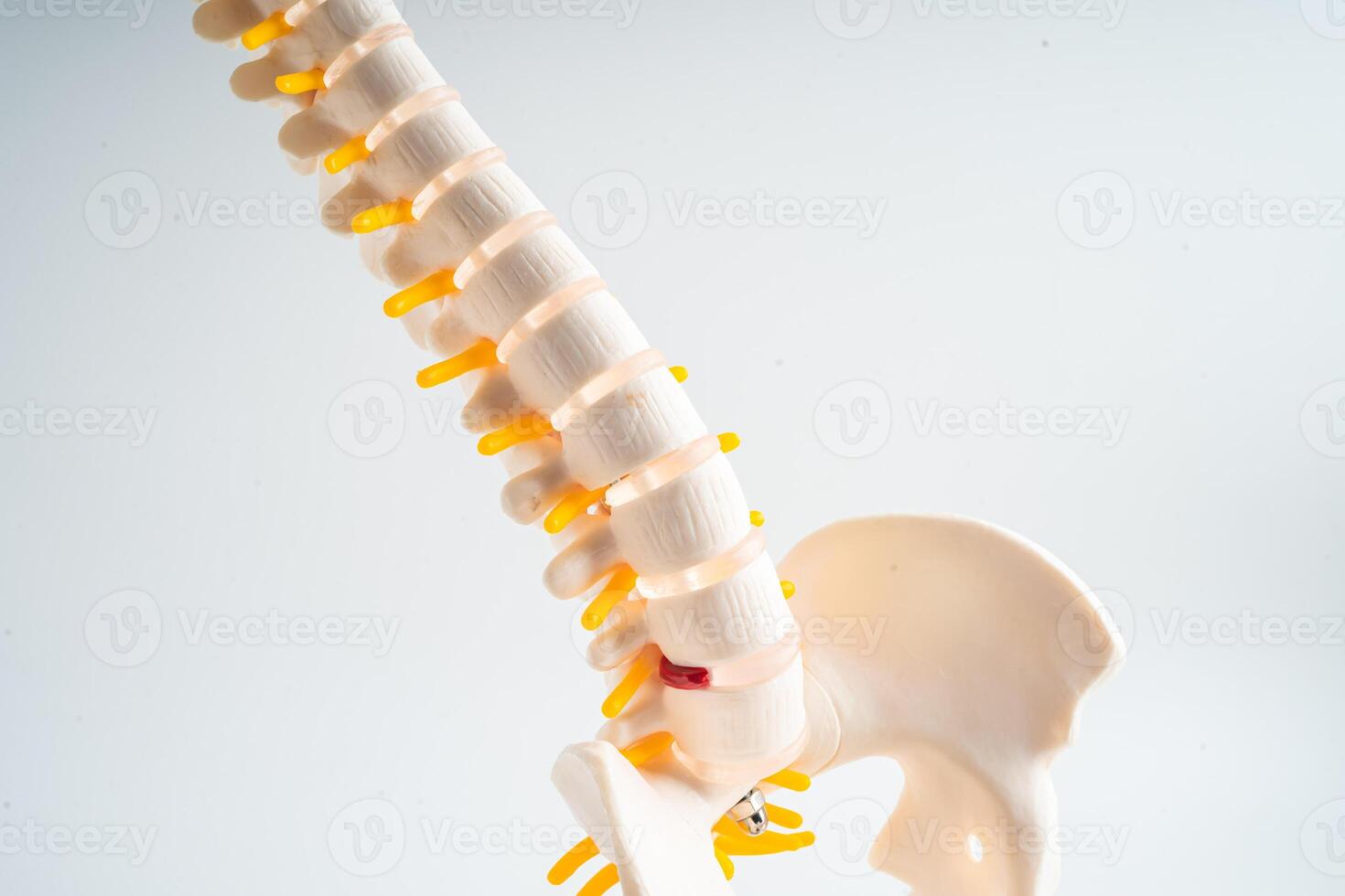 Lumbar spine displaced herniated disc fragment, spinal nerve and bone. Model for treatment medical in the orthopedic department. photo