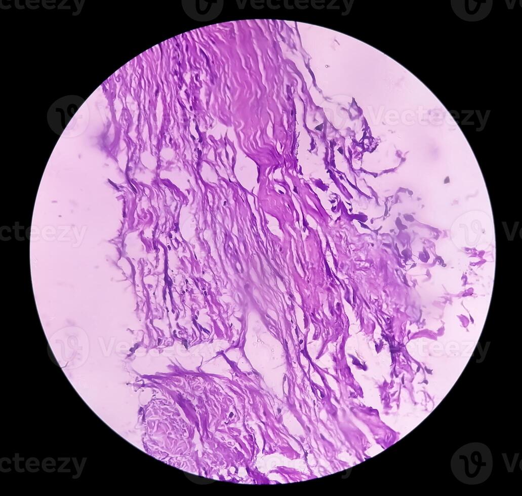 Photomicrograph of histological slide showing Lobular capillary hemangioma on finger. photo