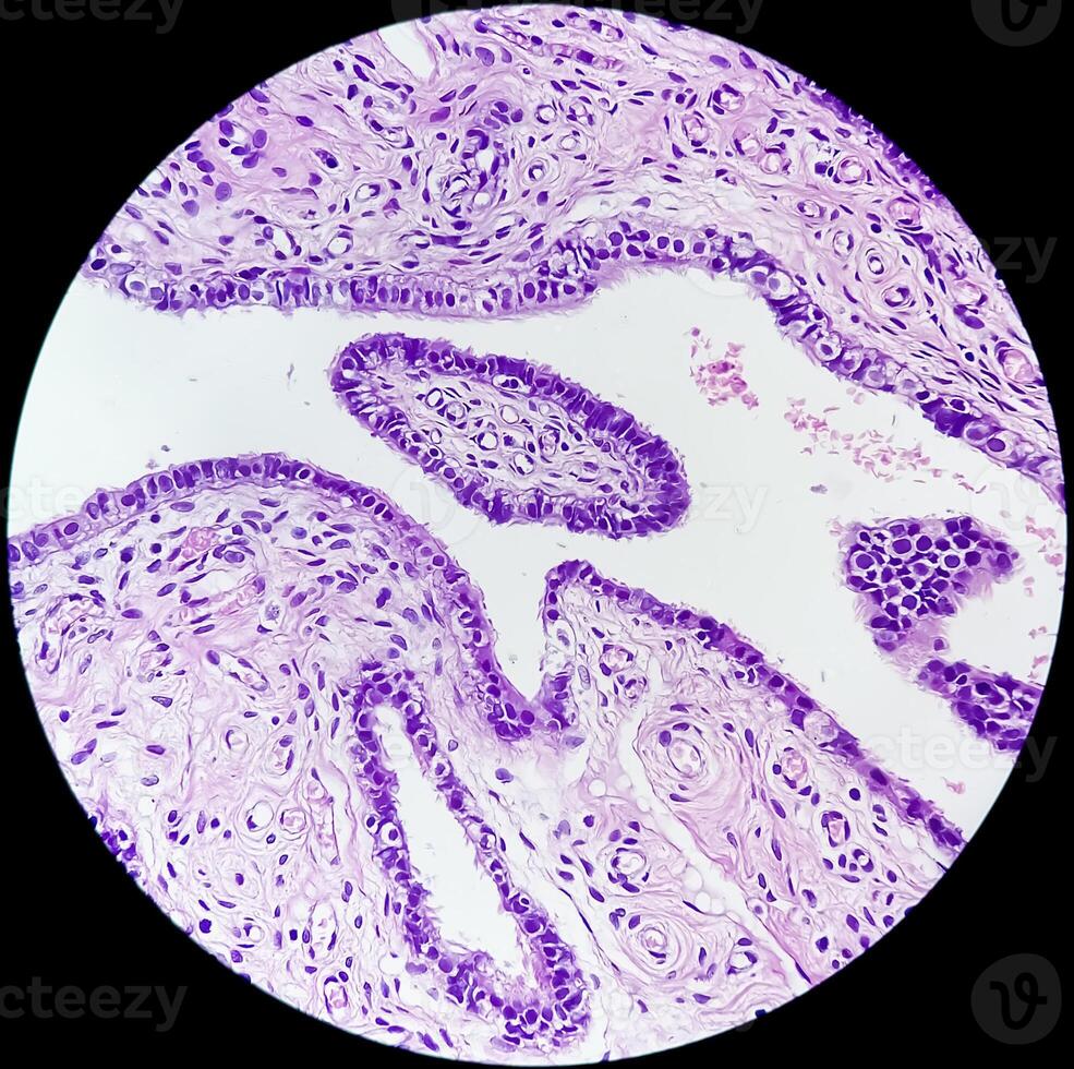 Histopathological photomicrograph of ovarian cyst showing Metastatic cystic teratoma. photo