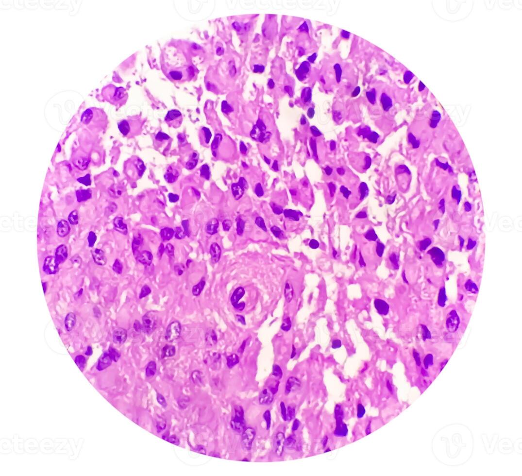 Human meningioma. Meningioma cells are relatively uniform, with a tendency to encircle one another, forming whorls and psammoma bodies, concentric laminated eosinophilic bodies that tend to calcify photo