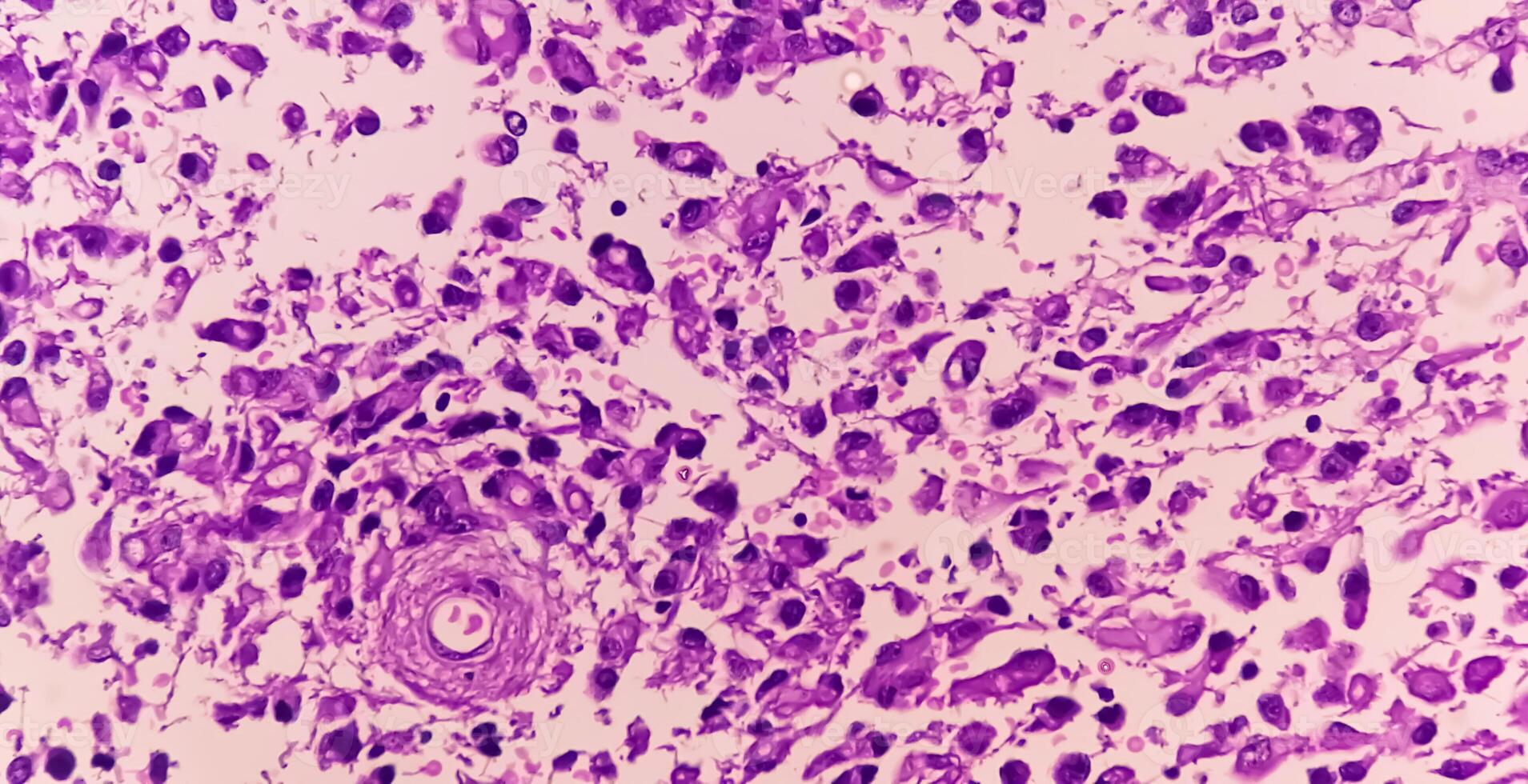 Human meningioma. Meningioma cells are relatively uniform, with a tendency to encircle one another, forming whorls and psammoma bodies, concentric laminated eosinophilic bodies that tend to calcify photo