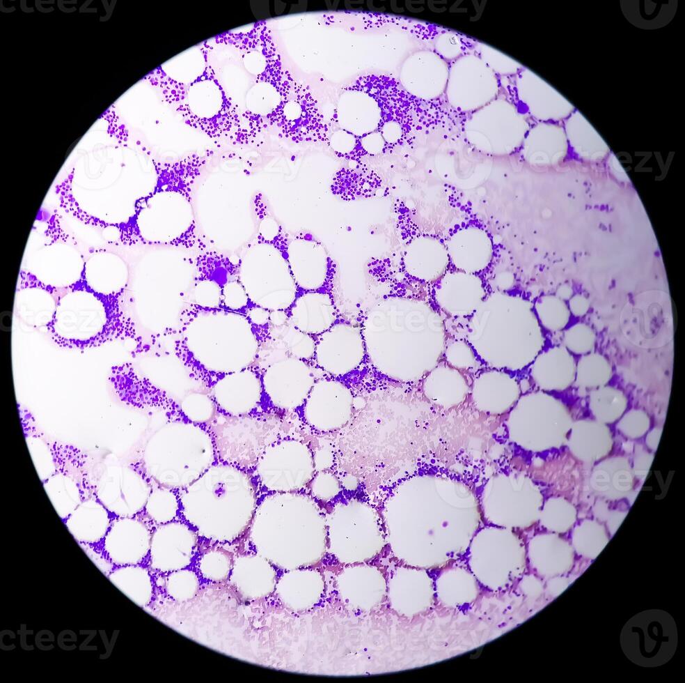 humano meningioma. meningioma células son relativamente uniforme, con un tendencia a rodear uno otro, formando espirales y psamoma cuerpos, concéntrico laminado eosinofílico cuerpos ese tender a calcificarse foto
