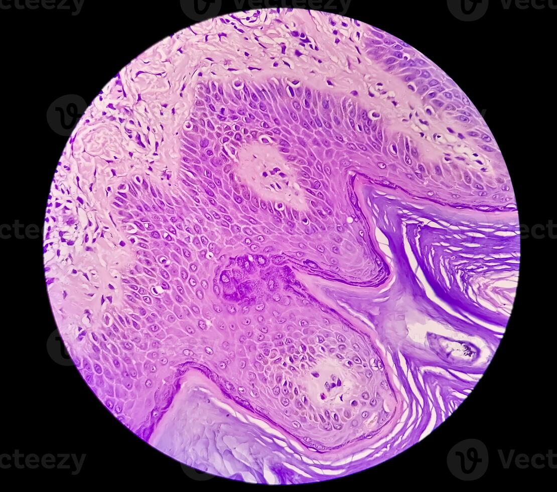 Histological Photomicrograph. Prurigo nodularis or PN is a chronic disorder of the skin. photo