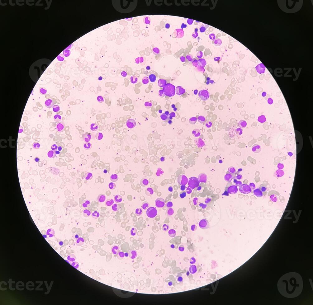 Bone marrow study, Suggestive of reactive marrow with dimorphic Erythroid hyperplasia photo