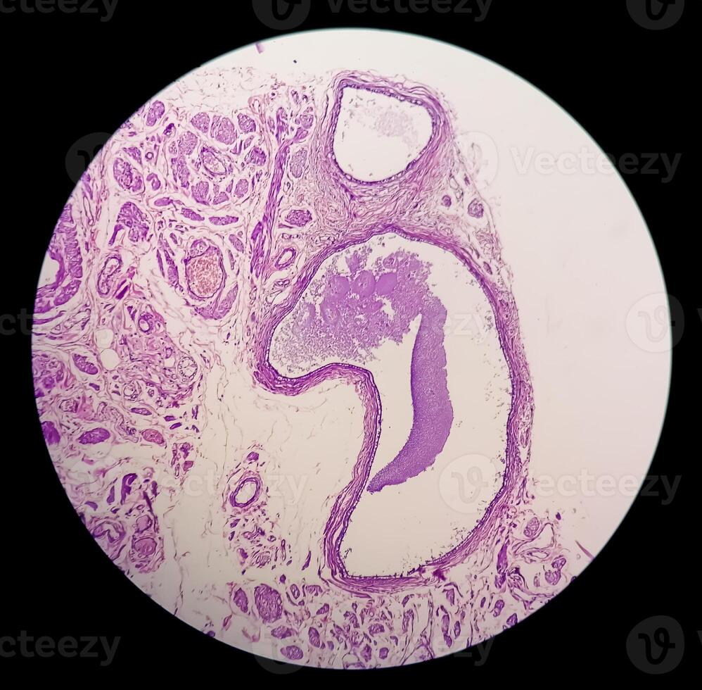 Histology, Peritoneal inclusion cyst. Paraovarian cysts, hydrosalpinx and low-grade cystic mesothelioma are usually considered in the differential diagnosis of PICs. photo