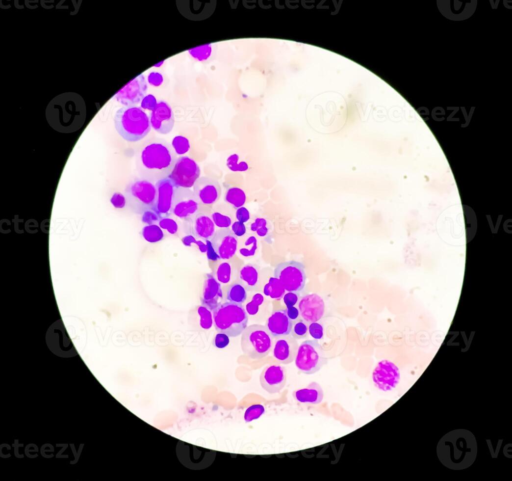 Photomicrograph Bone marrow study, Megakaryocytic Hyperplasia photo