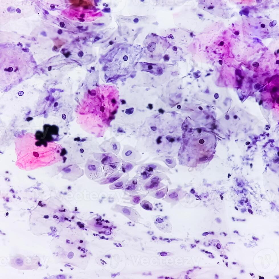 Paps smear analysis, Superficial squamous cell, metaplastic squamous cell, koilocytes cell. HPV related change photo