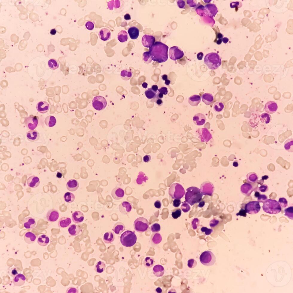 Bone marrow study, Suggestive of reactive marrow with dimorphic Erythroid hyperplasia photo