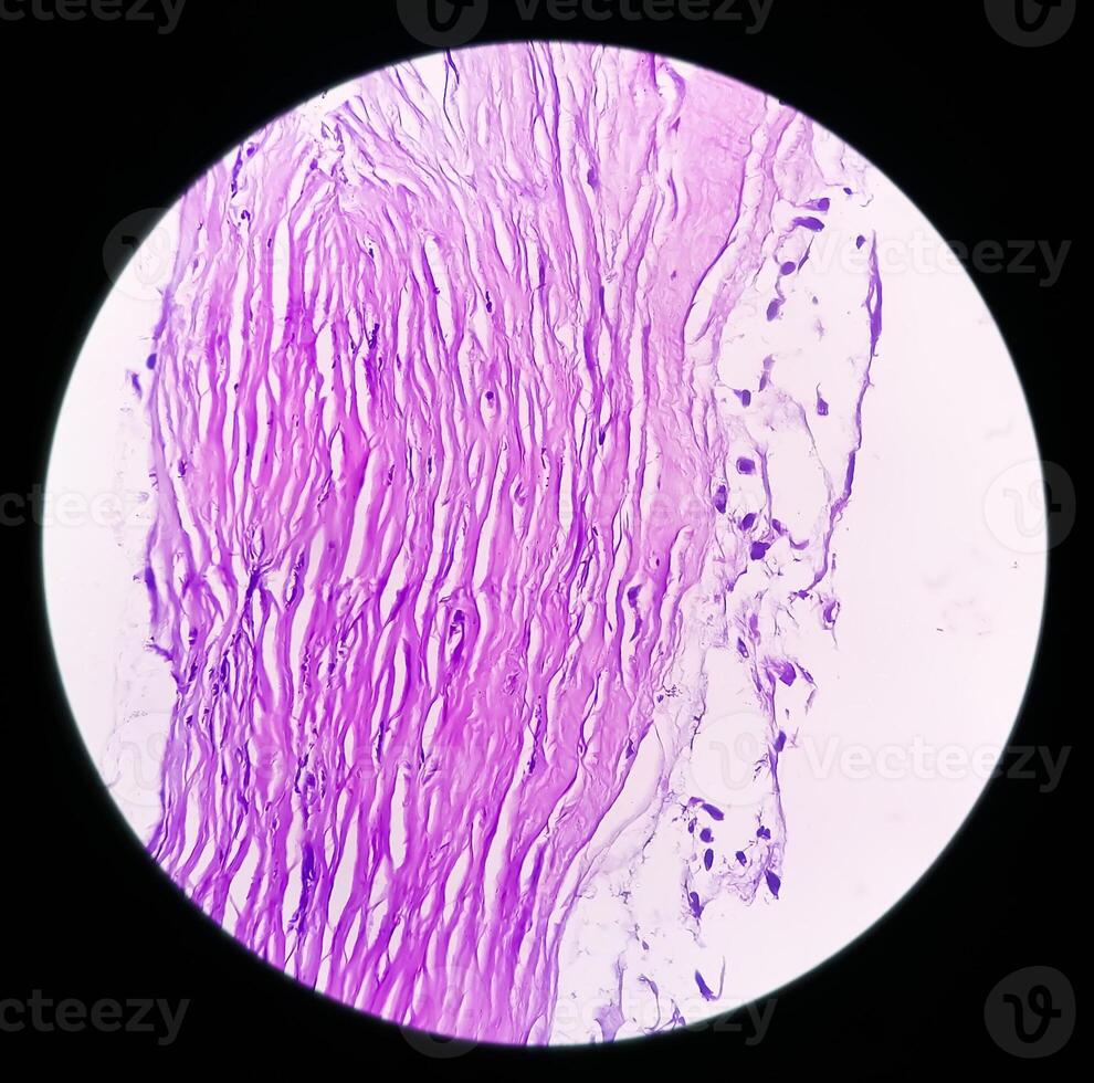 microfotografía de histológico diapositiva demostración lobular capilar hemangioma en dedo. foto