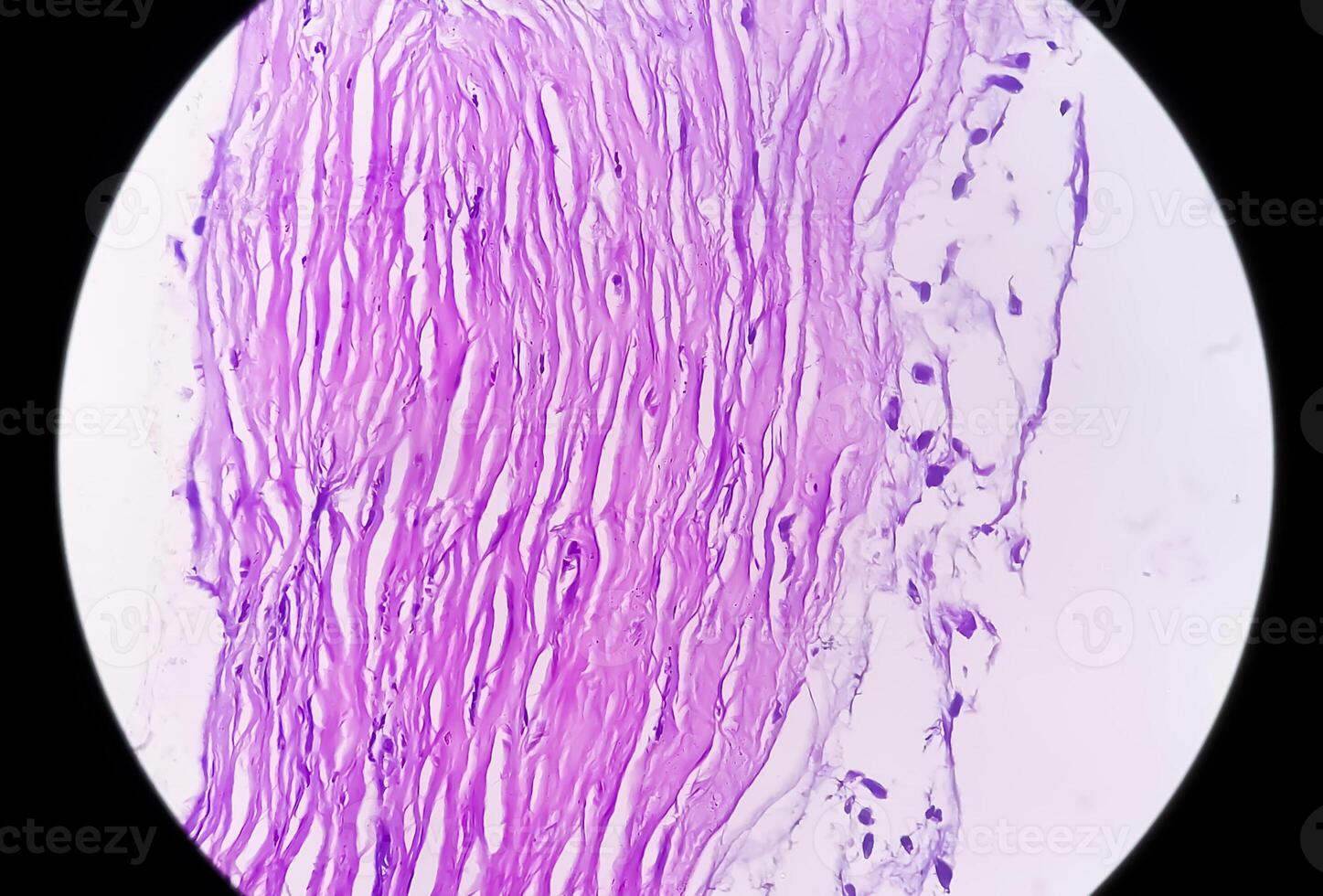 Photomicrograph of histological slide showing Lobular capillary hemangioma on finger. photo