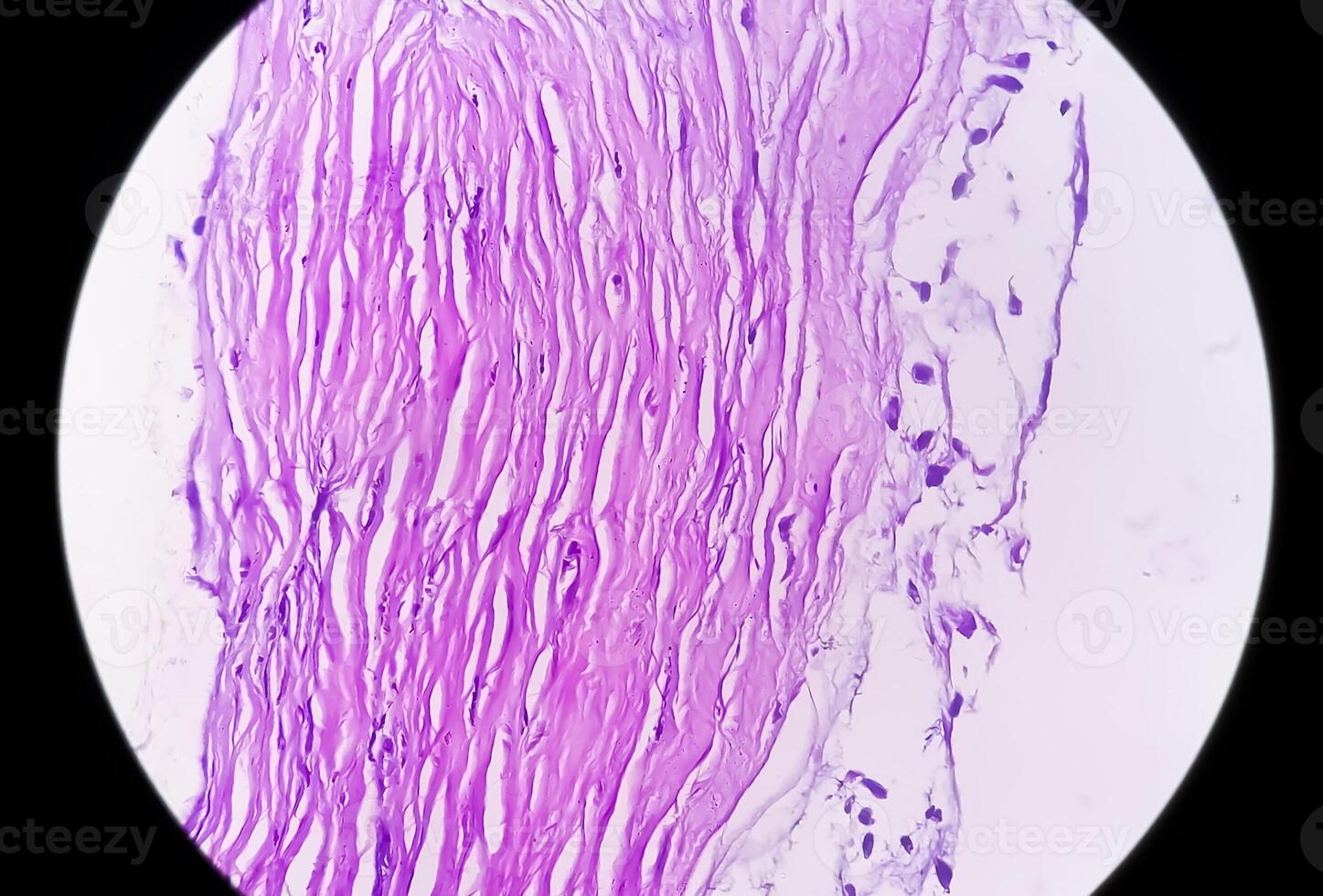 microfotografía de histológico diapositiva demostración lobular capilar hemangioma en dedo. foto