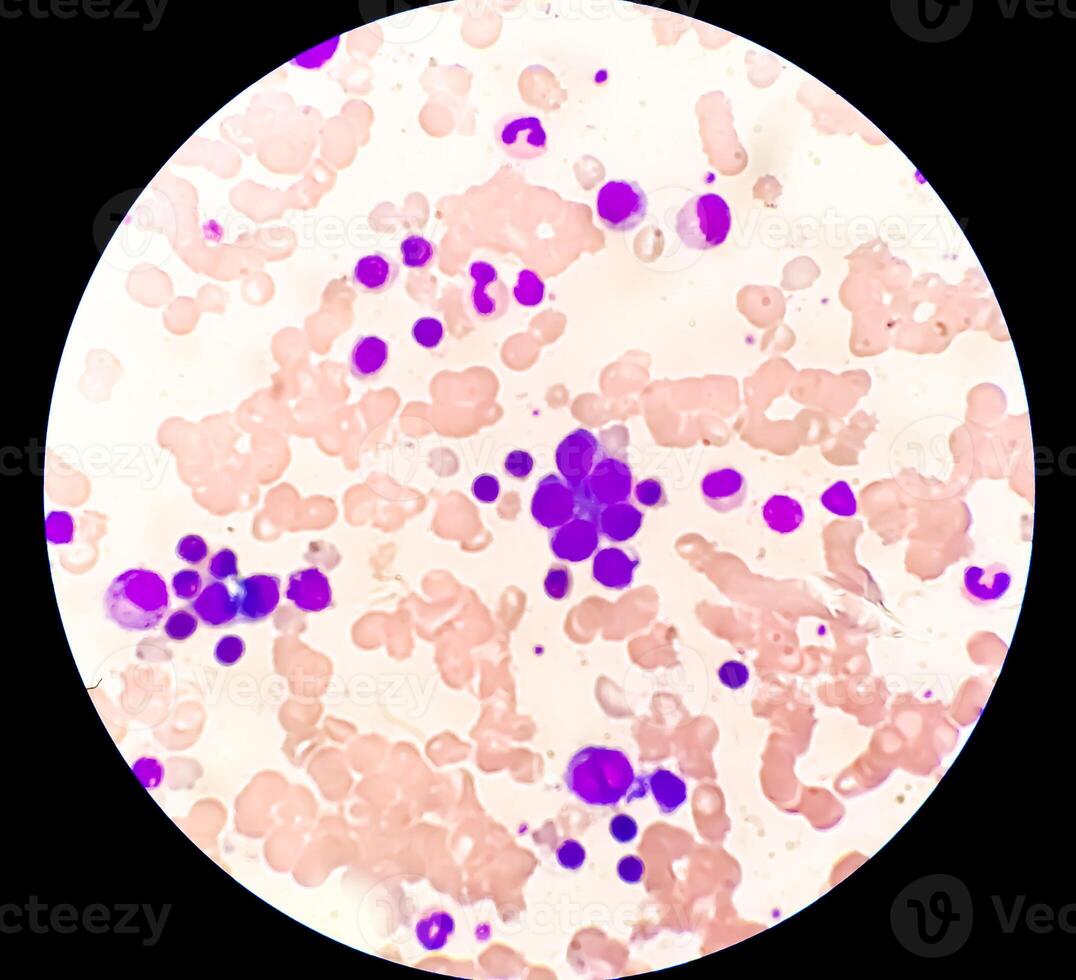 Photomicrograph Bone marrow study, Megakaryocytic Hyperplasia photo