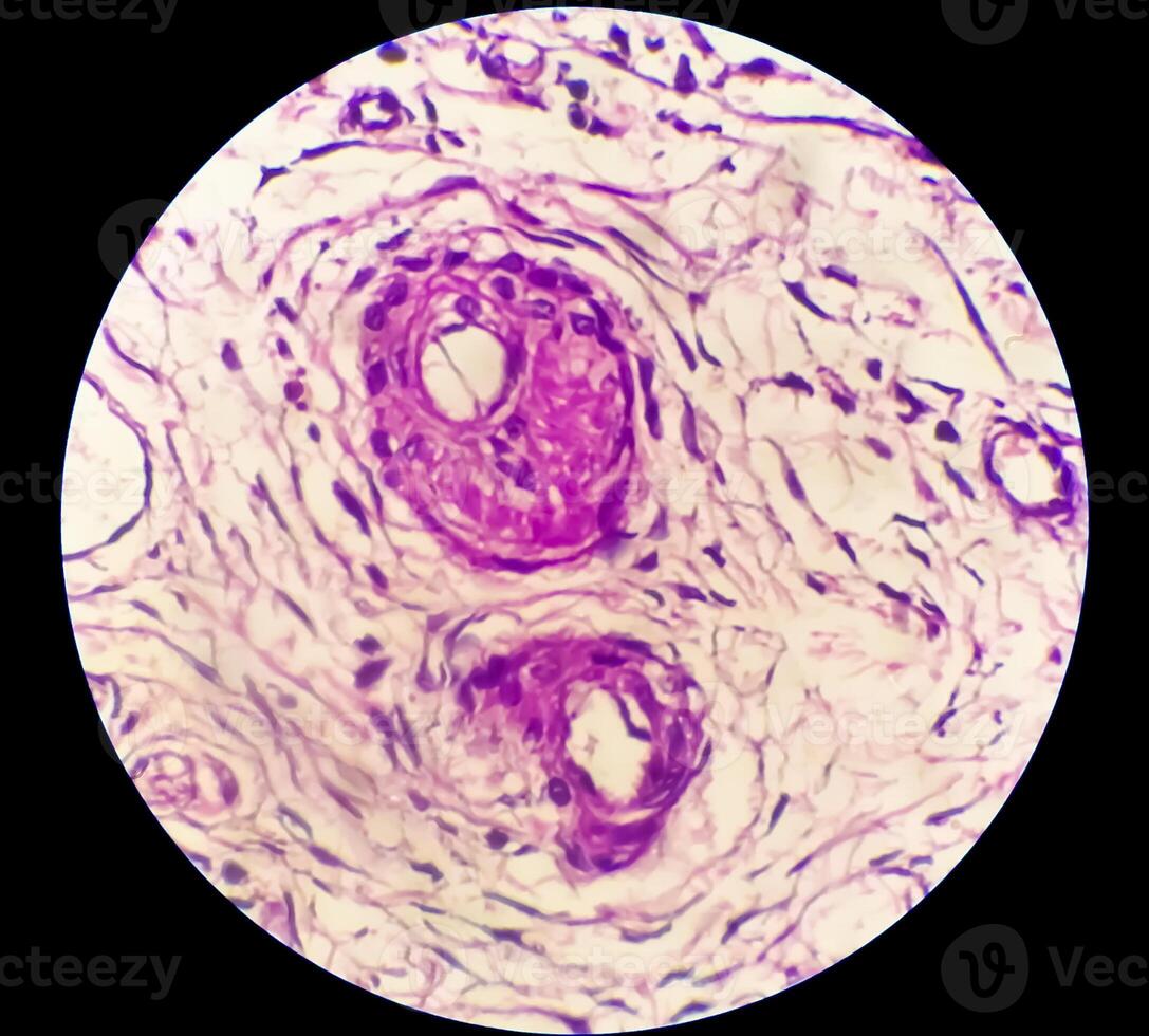 Histology, Peritoneal inclusion cyst. Paraovarian cysts, hydrosalpinx and low-grade cystic mesothelioma are usually considered in the differential diagnosis of PICs. photo