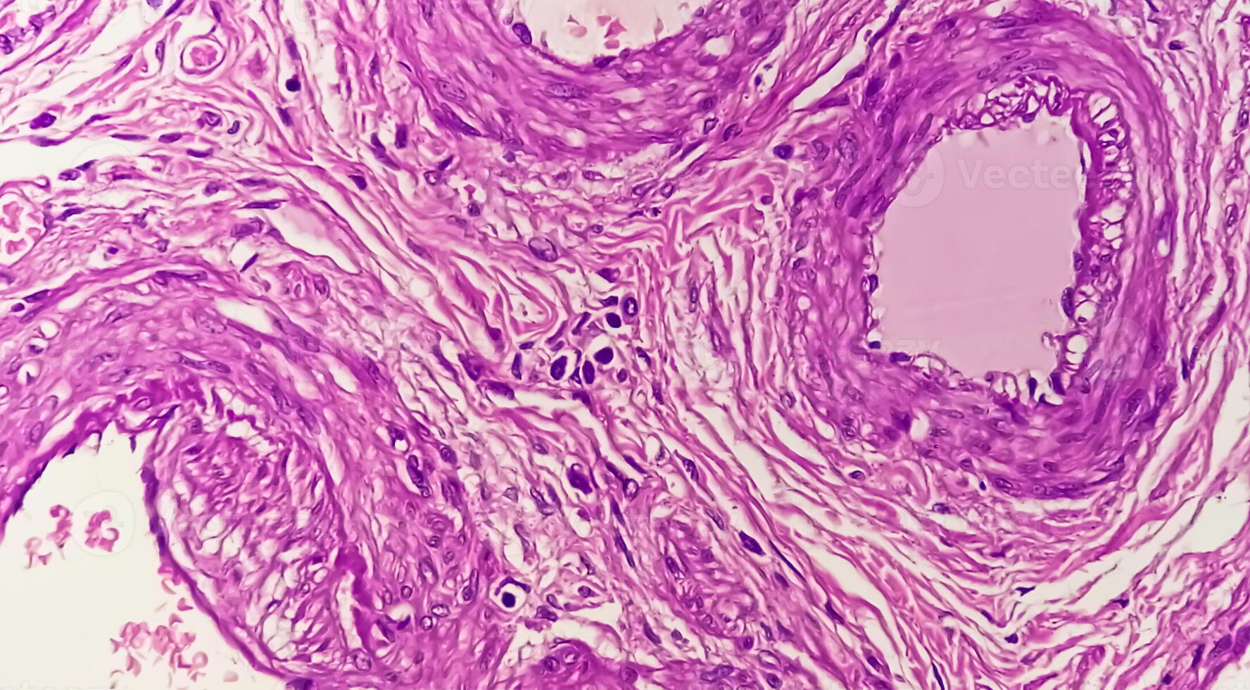 Histology, Peritoneal inclusion cyst. Paraovarian cysts, hydrosalpinx and low-grade cystic mesothelioma are usually considered in the differential diagnosis of PICs. photo