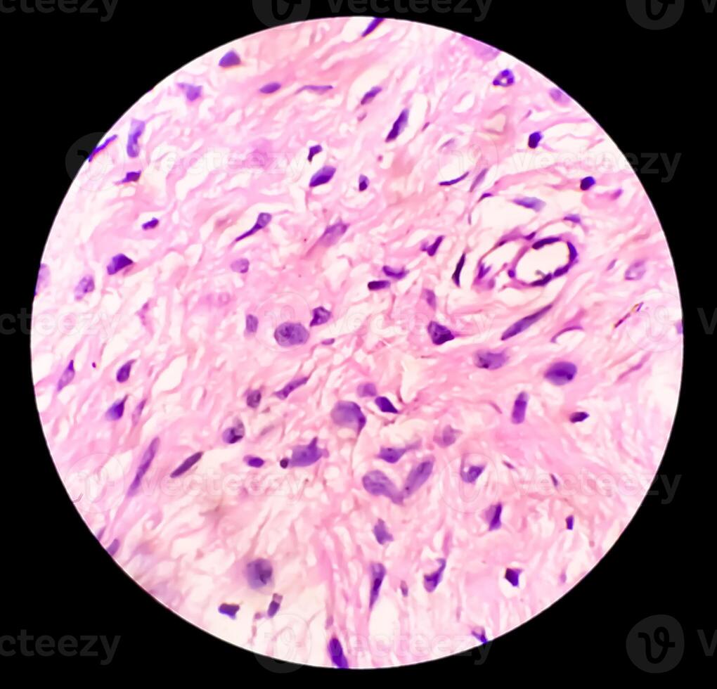 Leg tissue biopsy, Photomicrographic image showing Fibromyxoma. Superficial Acral Fibromyxoma, rare slow growing myxoid tumor photo
