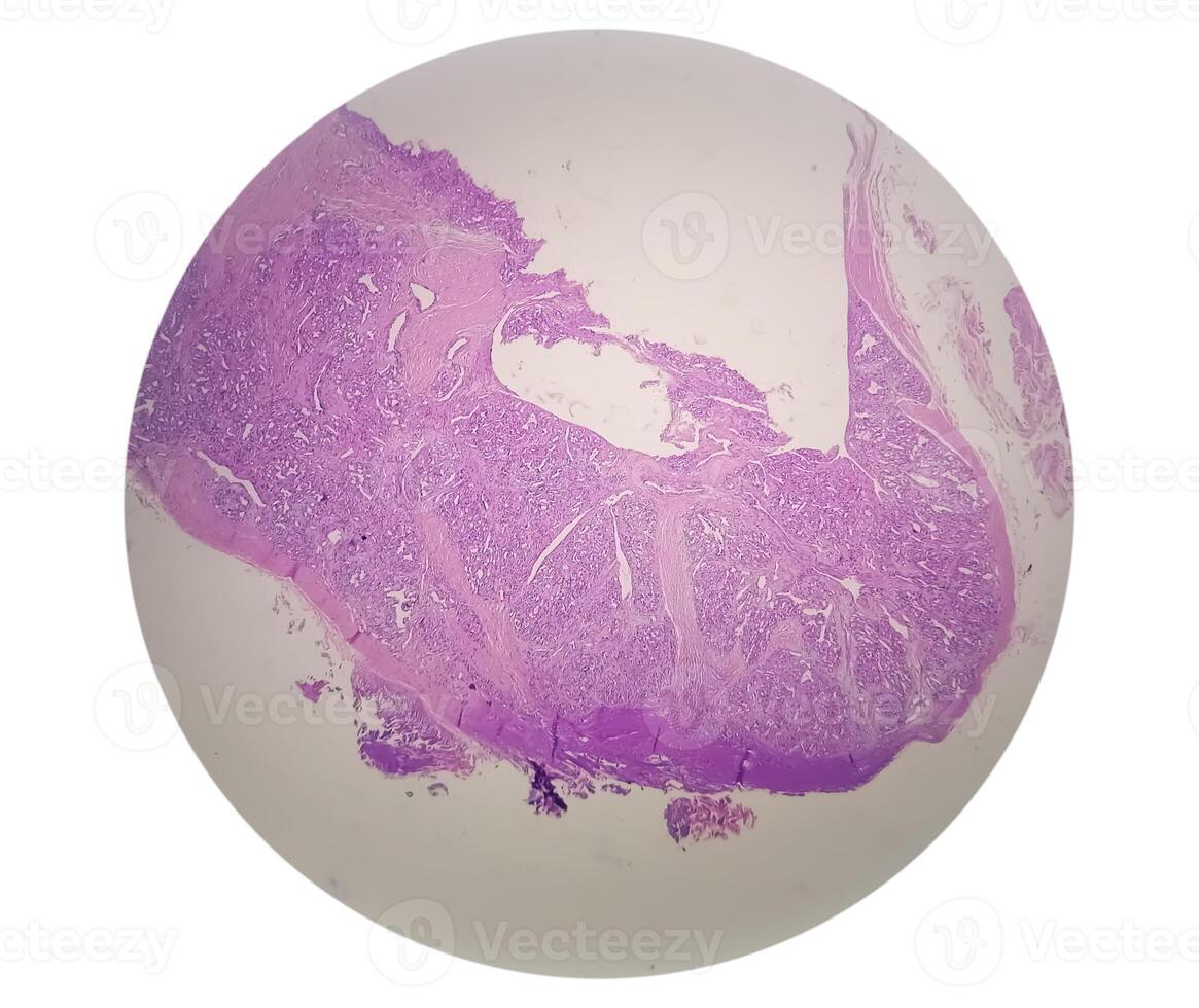 Photomicrograph of histological slide showing Lobular capillary hemangioma on finger. photo