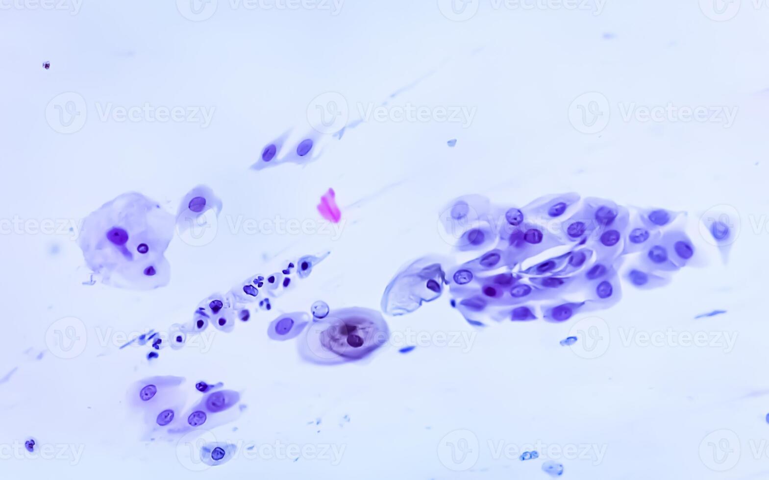 Paps smear analysis, Superficial squamous cell, metaplastic squamous cell, koilocytes cell. HPV related change photo