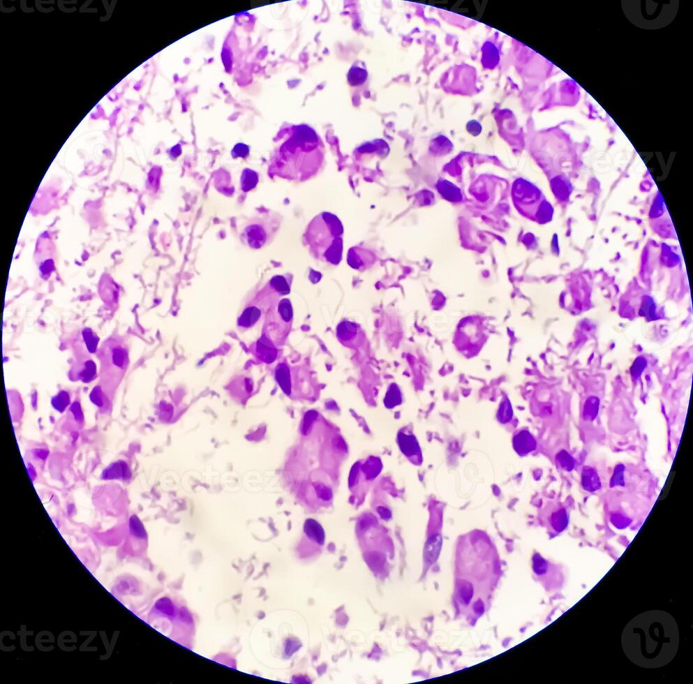 Human meningioma. Meningioma cells are relatively uniform, with a tendency to encircle one another, forming whorls and psammoma bodies, concentric laminated eosinophilic bodies that tend to calcify photo