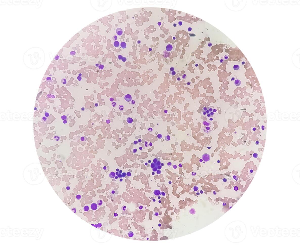 Photomicrograph Bone marrow study, Megakaryocytic Hyperplasia photo