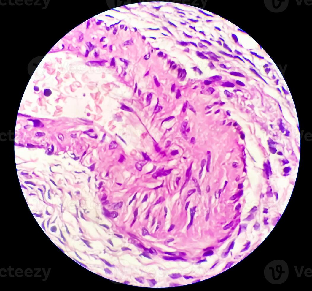 histología, peritoneal inclusión quiste. paraovárico quistes, hidrosálpinx y grado bajo cístico mesotelioma son por lo general considerado en el diferencial diagnóstico de fotos. foto