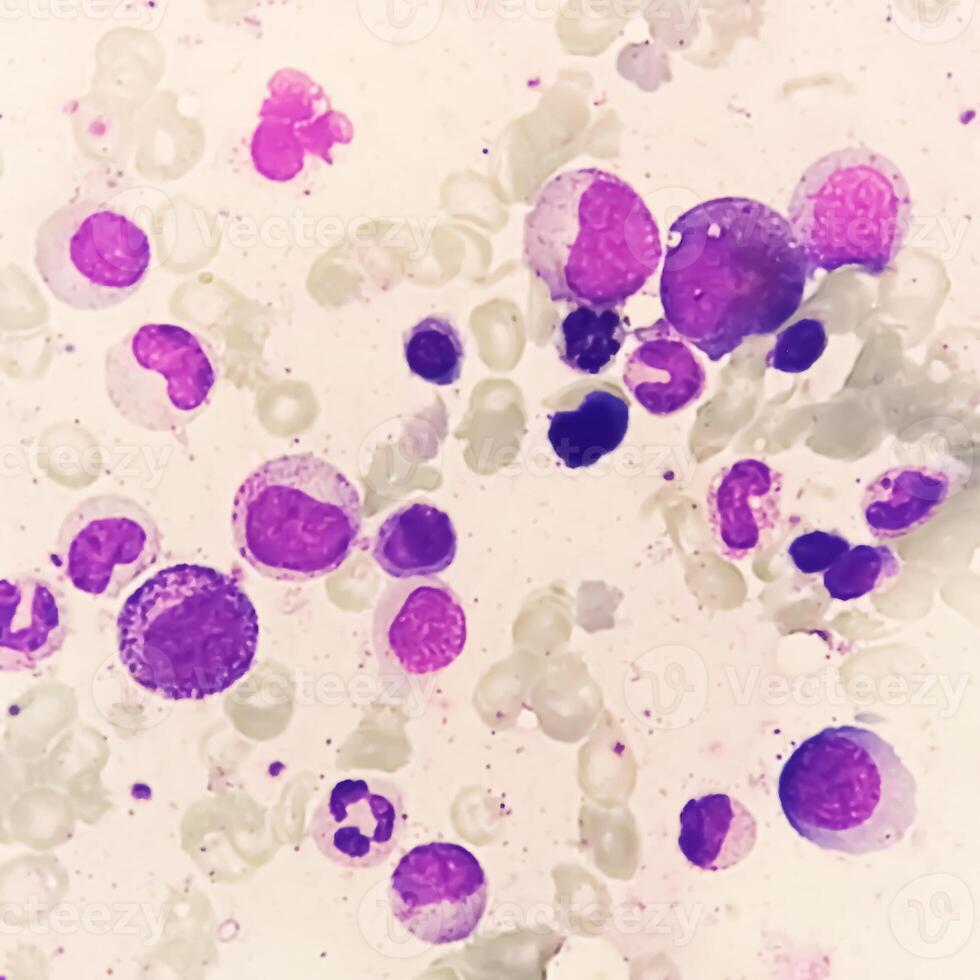 Bone marrow study, Suggestive of reactive marrow with dimorphic Erythroid hyperplasia photo