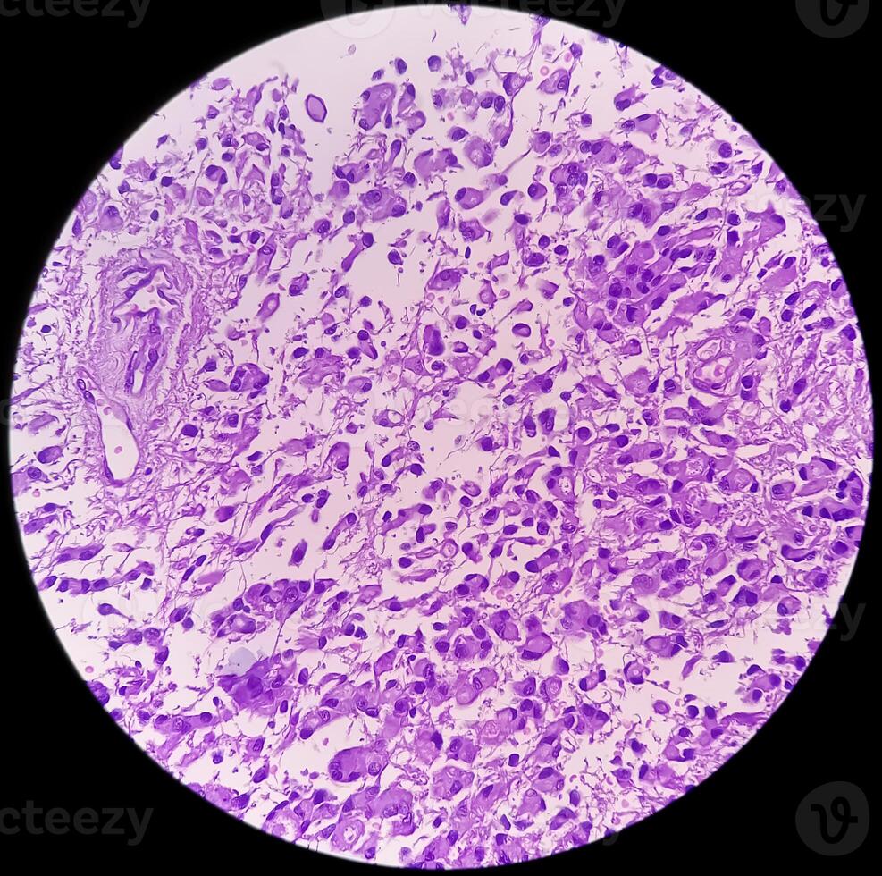 Human meningioma. Meningioma cells are relatively uniform, with a tendency to encircle one another, forming whorls and psammoma bodies, concentric laminated eosinophilic bodies that tend to calcify photo