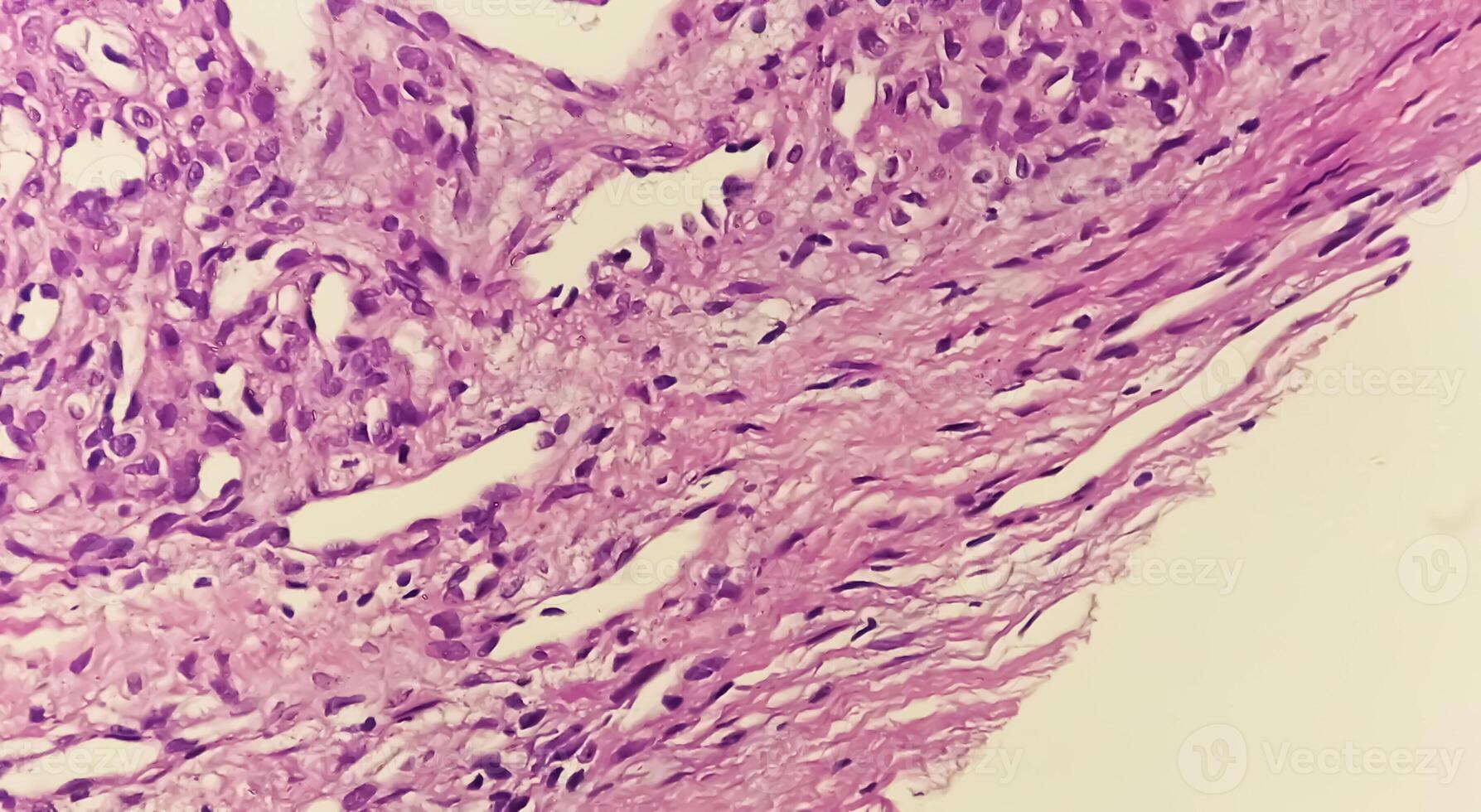 Photomicrograph of histological slide showing Lobular capillary hemangioma on finger. photo