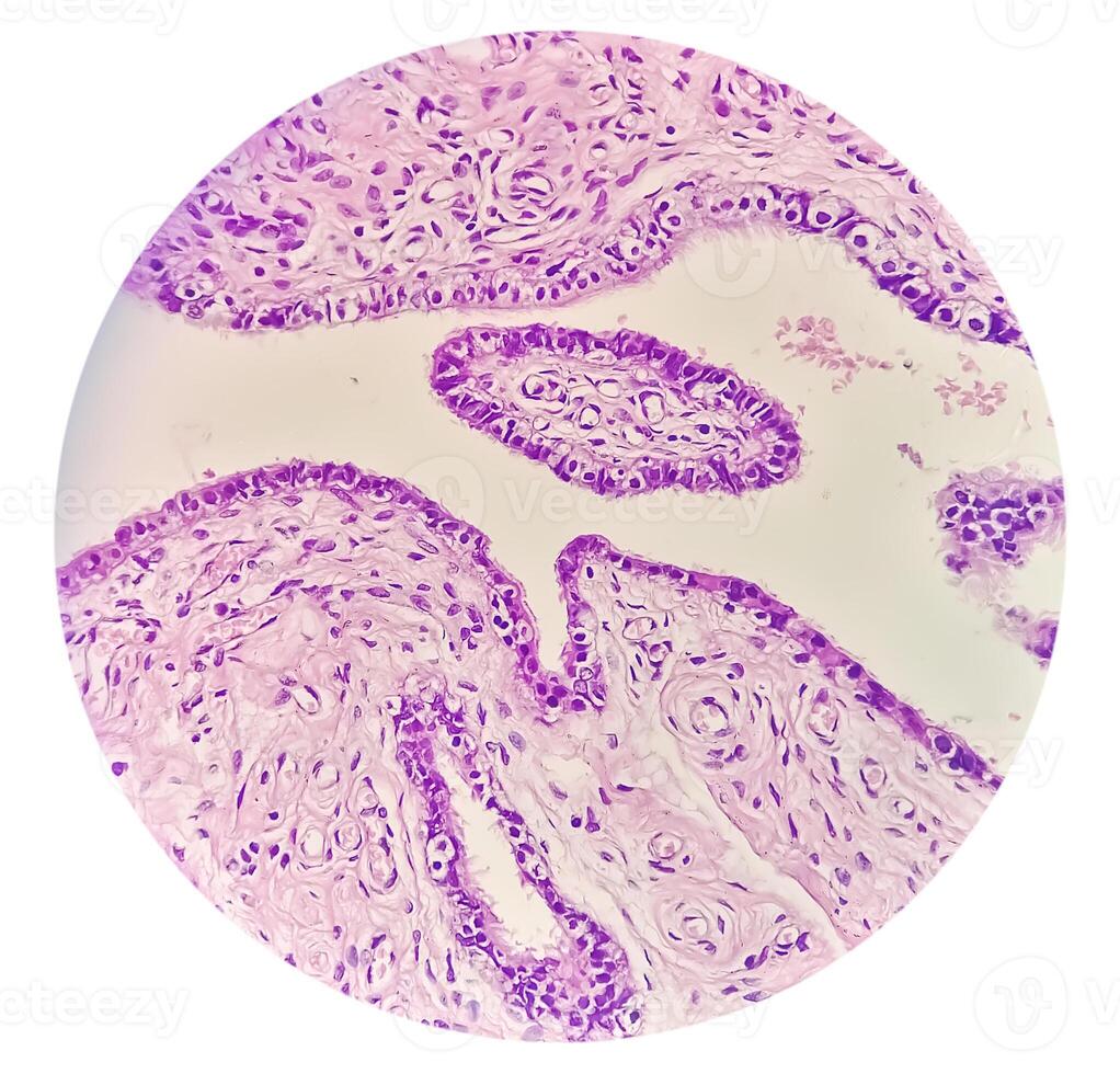 Histopathological photomicrograph of ovarian cyst showing Metastatic cystic teratoma. photo