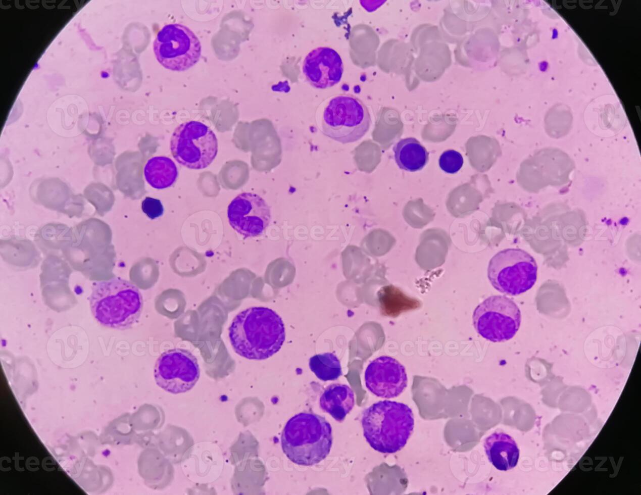 Bone marrow study, Suggestive of reactive marrow with dimorphic Erythroid hyperplasia photo