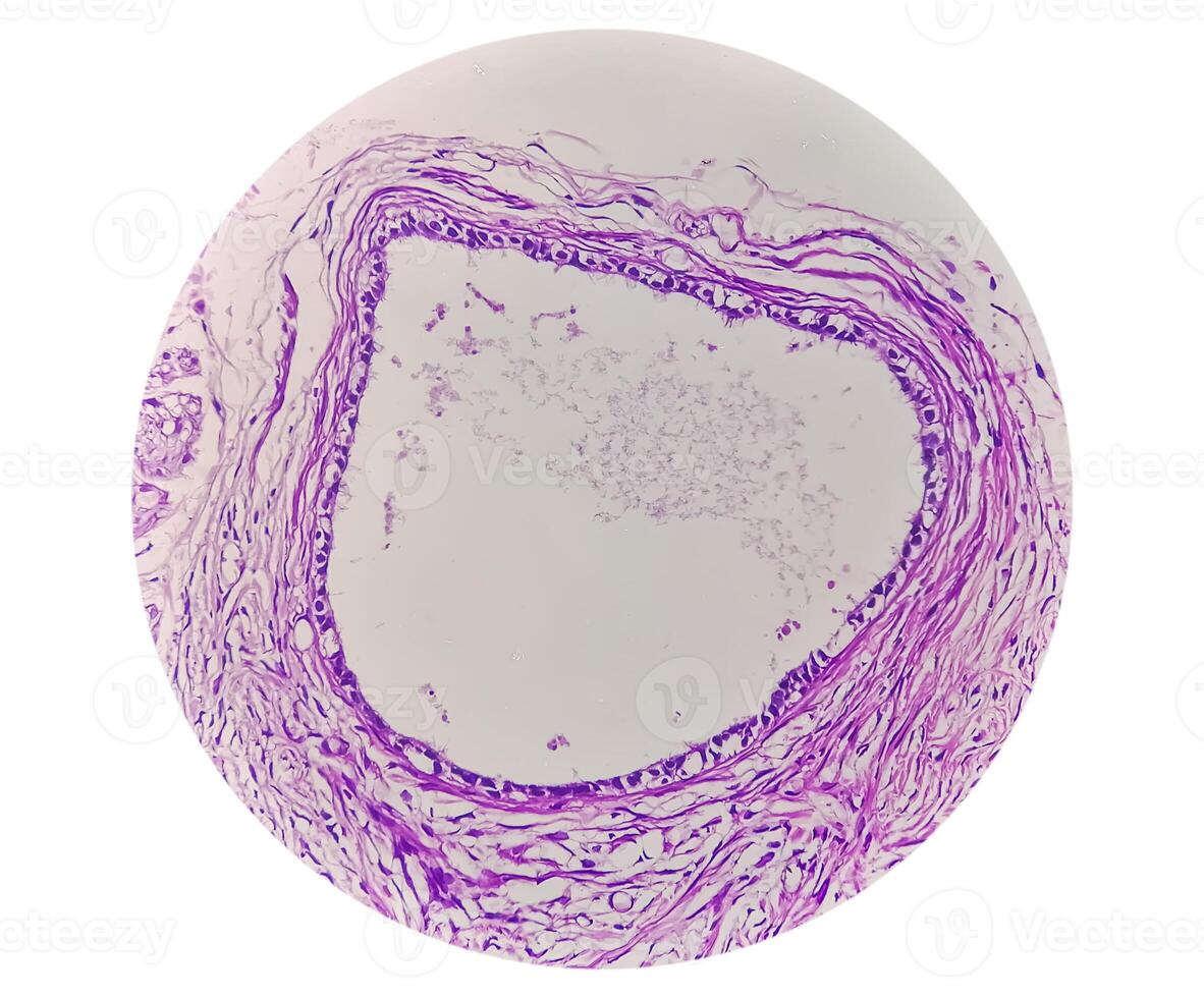 Histology, Peritoneal inclusion cyst. Paraovarian cysts, hydrosalpinx and low-grade cystic mesothelioma are usually considered in the differential diagnosis of PICs. photo