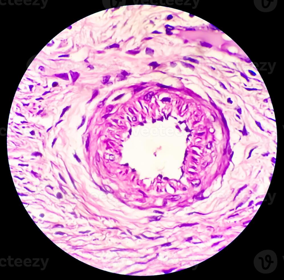 histología, peritoneal inclusión quiste. paraovárico quistes, hidrosálpinx y grado bajo cístico mesotelioma son por lo general considerado en el diferencial diagnóstico de fotos. foto