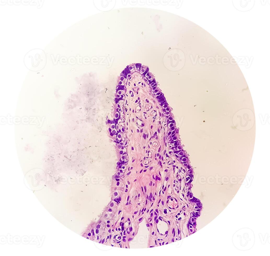 Histopathological photomicrograph of ovarian cyst showing Metastatic cystic teratoma. photo