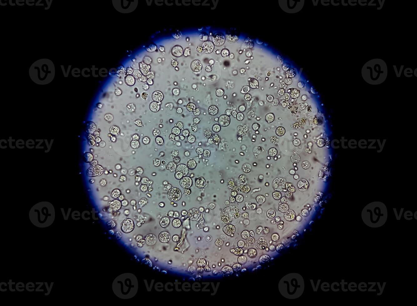 Photomicrograph of urinalysis showing plenty pus cells, urinary tract infection. photo