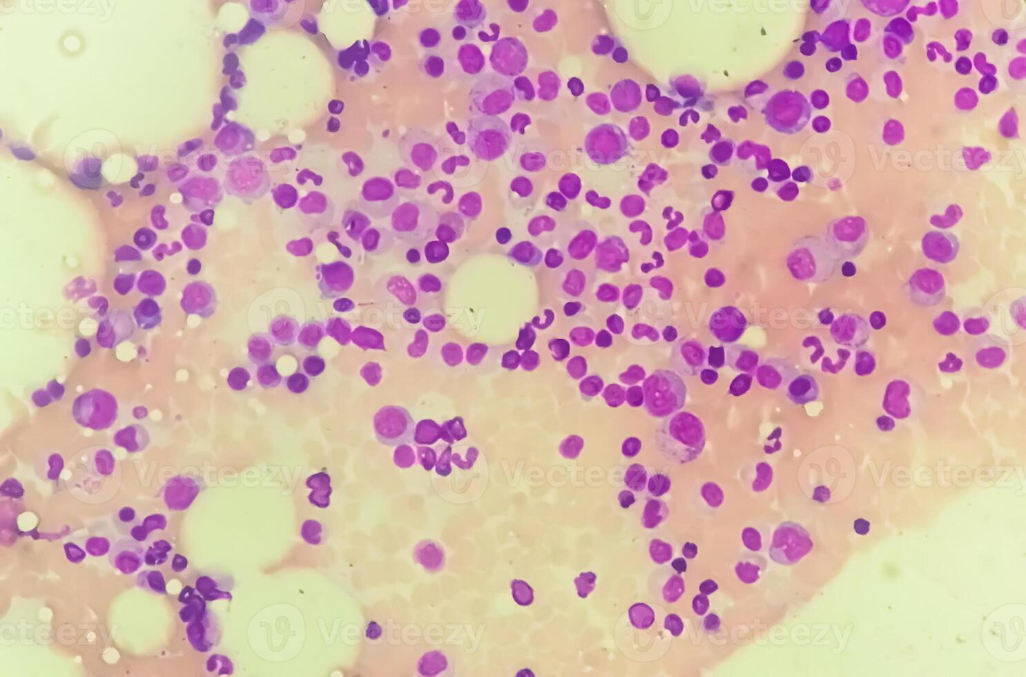 Photomicrograph Bone marrow study, Megakaryocytic Hyperplasia photo