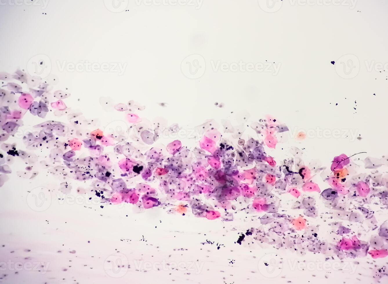 Paps smear analysis, Superficial squamous cell, metaplastic squamous cell, koilocytes cell. HPV related change photo