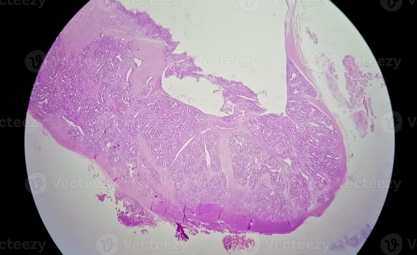 microfotografía de histológico diapositiva demostración lobular capilar hemangioma en dedo. foto